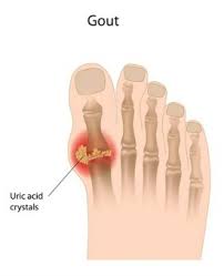 how to fix gout in the toes or feet or
                    arthritis anywhere