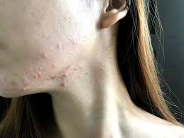 A closed comedo (singular of comedones). How I Got Rid Of My Closed Comedones Small Bumps On My Jawline Dry Skin Advice