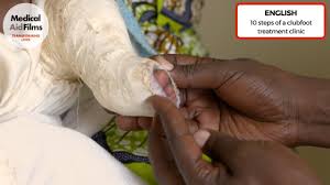 Results are better with earlier treatment but there are some experts. 10 Steps Of A Clubfoot Treatment Clinic Youtube