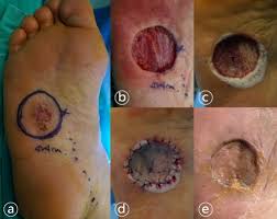Aside from looking like a changing mole, a melanoma on the foot can appear as a: Skin Graft Using Matriderm For Plantar Defects After Excision Of Cmar