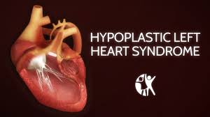 Hypoplastic Left Heart Syndrome Hlhs Diagnosis And Norwood Procedure