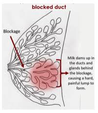Check spelling or type a new query. Blocked Milk Ducts Ultrasound May Be The Solution The Healthy Body Company