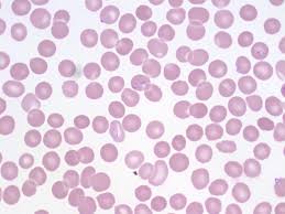 Plasmodium falciparum / drug effects*. Malaria A Laboratory Guide To Clinical Hematology