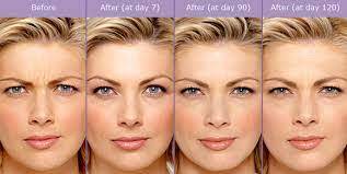 How long for botox to work in forehead. Erase Your Age With Botox How Long Does It Take For Botox To Work