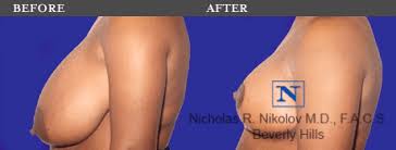 In both of these situations, the breast reduction is considered medically necessary does blue cross blue shield cover breast reduction ? Breast Reduction Beverly Hills Ca The Nikolov Center For Plastic Surgery