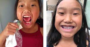 Your dentist should be able to review with you the advantages and disadvantages of one option over another to treat crooked teeth. Fixing Crooked Teeth Is Not Just About Looks Kansas City Nonprofit Seeks To Change Lives Kcur 89 3 Npr In Kansas City Local News Entertainment And Podcasts