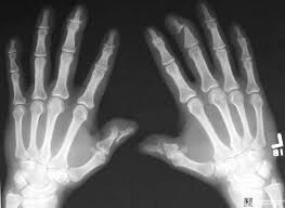 Pencil In Acup Deformity Of Psoriatic Arthritis Inflammatory Arthritis Autoimmune Arthritis Arthritis