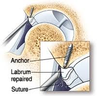 Image result for Hip Labral Tear
