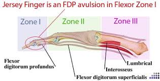 The flexor digitorum profundus originates from the anterior. Jersey Finger Hand Orthobullets
