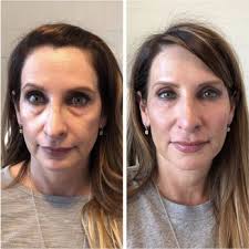 TOP 10 BEST Lip Injections near Claremont, CA 91711