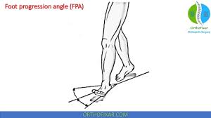 Image result for Foot Progression Angle