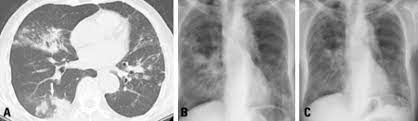 View Of Lady Windermere Syndrome The Southwest Respiratory And Critical Care Chronicles