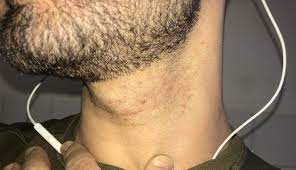 What do ingrown hairs look like? 7 Tips For Men To Help You Reduce Ingrown Hair Lifeberrys English Dailyhunt