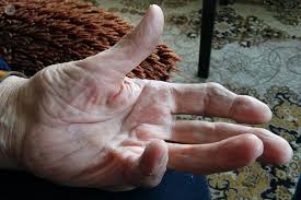 Maybe you would like to learn more about one of these? Dupuytren S Contracture The Viking Disease Explained