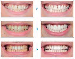 We did not find results for: How Do I Get My Teeth Looking Whiter Ocean Breeze Dental