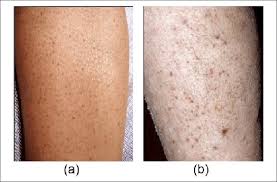 In old age, skin becomes thinner and fragile. Hyerkeratosis A And Perifollicular Based Hemorrhage With Red To Download Scientific Diagram