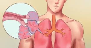 اعراض جلطة الرئة وطرق علاجها اليوم السابع