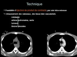 Cet examen est souvent réalisé en complément de radiographie ou d'échographie. Scanner Thoracique Normal Ppt Video Online Telecharger