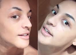 Contudo, hoje, iremos relembrar com a drag queen era antes da fama. Pabllo Vittar Retira Curativos E Exibe Novo Nariz Ficou Bafo Quem Quem News