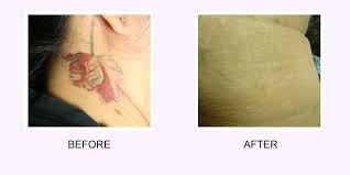 My new tattoo worst tattoo ever! How Much Tattoo Can Laser Tattoo Removal Really Remove