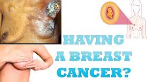 Rach dimare (breast cancer, invasive ductal carcinoma, stage 2, triple positive) i immediately called my husband, and i literally said, 'hey, i just got the results.' i think he knew. Breast Cancer How To Know If You Have Breast Cancer Youtube