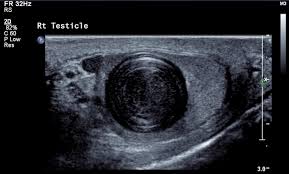 Intratesticular Epidermoid Cyst Here Is A Well Circumscribed Intratesticular Mass At The Upper Pole Epidermoid Cyst Diagnostic Medical Sonography Ultrasound