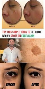 Try This Simple Trick To Get Rid Of Brown Spot On Face And Skin Brown Spots On Face Spots On Face Brown Spots On Skin