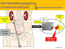 Klinikum Ingolstadt Gmbh Harnleiterspiegelung Ureterorenoskopie
