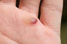 Ice is known for bringing down any kind of swelling, and helps reduce internal bleeding. Blood Blisters Causes Diagnosis And Treatment
