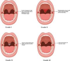 Image result for Uvulitis