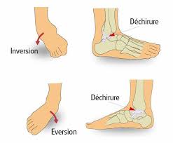 L'intérieur de la jambe, au dessus de la cheville est gonflé et douloureux à la marche. Cheville Et Si C Etait Une Entorse Planete Sante