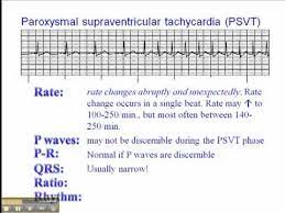 To diagnose supraventricular tachycardia, your doctor will ask questions about your symptoms and your medical history and perform a physical exam. Ecg Paroxysmal Supraventricular Tachycardia Psvt Youtube