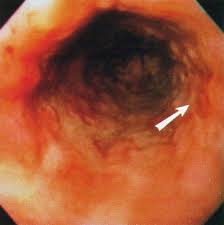 In patients with candida and hsv esophagitis, the infections commonly involve only the esophagus and oropharynx. Cytomegalovirus Esophagitis In An Immunocompetent Host Gastrointestinal Endoscopy