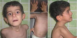 Defect in proline synthesis: pyrroline-5-carboxylate reductase 1 deficiency  leads to a complex clinical phenotype with collagen and elastin  abnormalities