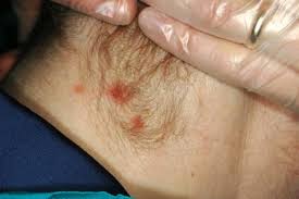 Syphilis The Renaissance Of An Old Disease With Oral Implications Springerlink