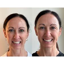 Ready to turn back the clock with subtle, natural-looking results? 💁‍♀️  🕰️ Just look at these incredible before and after results! Sculptra is the  secret to gradually improving volume and skin texture,