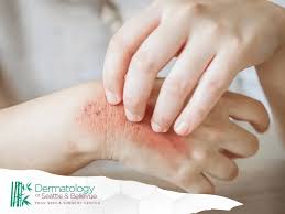 Image result for Skin Infection
