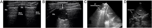 And visible when both pleura are separates by a structure that allows ultrasound transmission; Lung Ultrasound In Children With Respiratory Tract Infections Viral Oaem