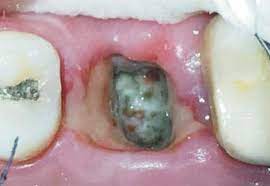Dry socket (after tooth extraction): I Accidently Poked My Wisdom Tooth Socket 8 Days After The Operation Will I Get Dry Socket I Was Using A Large Plastic Syringe My Doctor Gave Me To Rinse The Socket