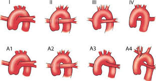 Truncus Arteriosus Thoracic Key