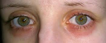Rote Hautirritation Unter Dem Auge Hilfe Gesundheit Und Medizin Schmerzen Haut