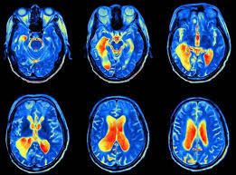 Icd-10-Cm Diagnosis Code G93.41 - Metabolic Encephalopathy