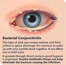 Image result for Bacterial Conjunctivitis