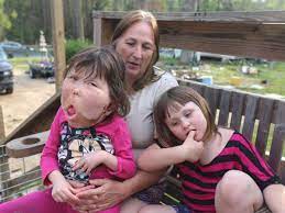 Rare Disease Day Top 20 Rare Diseases In The World Boldsky Com