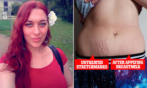 Lemon juice is the easiest treatment to fade stretch marks. How Breastmilk Faded Mother S Stretch Marks Daily Mail Online