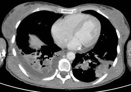 Image result for Lung Abscess