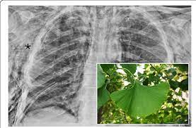 5 out of 5 stars (325) $ 29.00. Ginkgo Leaf Sign A Chest Radiograph Of A Patient With Diffuse Download Scientific Diagram