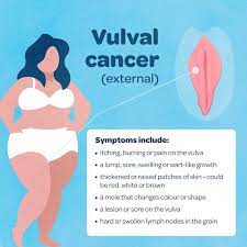 In 2020, it is estimated that 933 new cases of cervical cancer will be diagnosed in australia. What Is Gynaecological Cancer And What Are The Symptoms Queensland Health