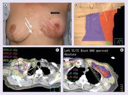 Image result for Inflammatory breast cancer