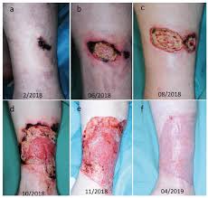 Retrospective study from 1999 through 2007. Diagnostic Challenge Of Bilateral Martorell Hypertensive Ischaemic Leg Ulcers Html Acta Dermato Venereologica